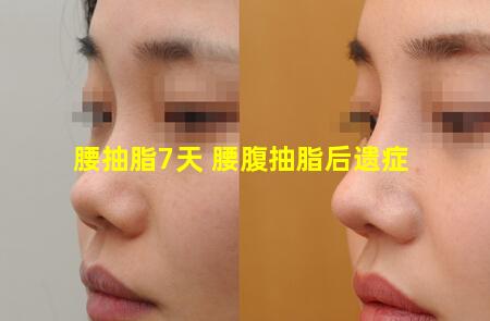 腰抽脂7天 腰腹抽脂后遗症